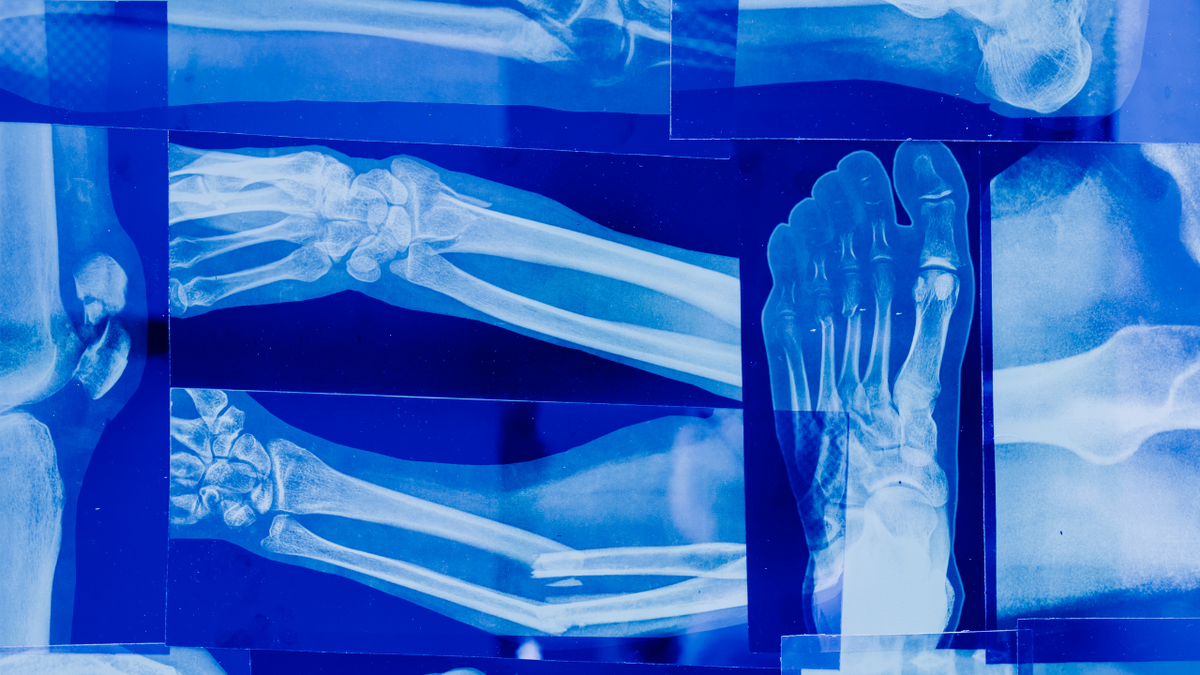 Bone Density After 40: The Supplements, Foods, and Habits That Actually Help